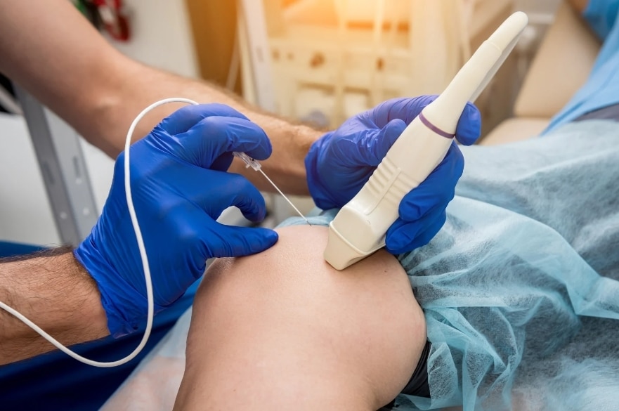 Radiofrequency Ablation