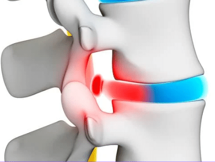 herniated disc